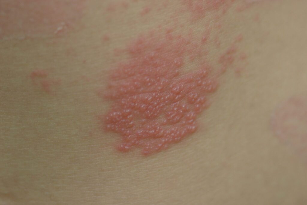 帯状疱疹はどのような合併症を引き起こす可能性がありますか?